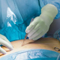 Proven Strategies for Successful Surgical Site Infection Wound Treatment