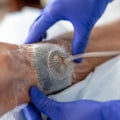 Proven Wound Care Management Strategies for Achieving Highly Rated Treatment Results