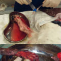 How The Mechanical Wound Debridement Procedure Aids In Effective Wound Treatment