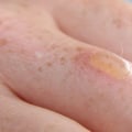 Effective Wound Treatment for 2nd Degree Burn Blister Healing Stages