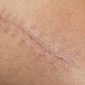 Expert Tips for Speeding Up Wound Healing