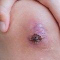 Innovative Techniques For Treating Slough Wound Tissue