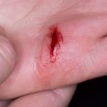 Expert Tips for Faster Wound Healing: How to Heal Wounds Quickly and Prevent Complications