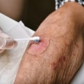 Expert Tips for Healing Chronic Wounds