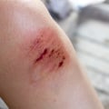 Edema Wound Treatment: Strategies For Healing And Managing Swelling