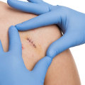 The Healing Process Uncovered: How Long Does It Take for Stitches to Dissolve After Treatment?