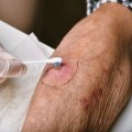 Expert Tips for Proper Wound Care and Healing