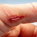 What Do Dissolvable Stitches Look Like? A Helpful Guide for Effective Wound Treatment