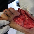 The Importance of Covering Wounds for Proper Healing