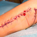 How to Navigate Normal Stitches Healing Stages With the Best Wound Care Practices