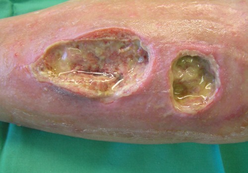 The Complex Process of Wound Healing: Understanding the Triggers and Factors