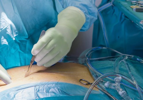 Proven Strategies for Successful Surgical Site Infection Wound Treatment