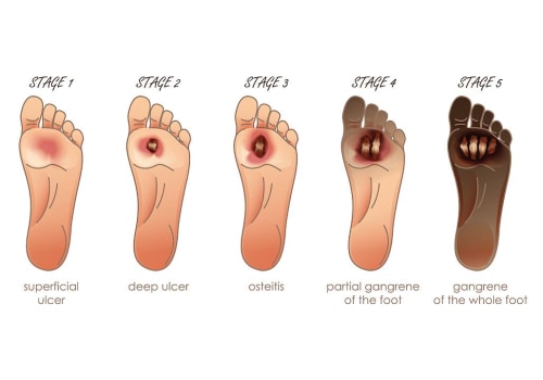 How to Identify and Manage Venous Ulcer Vs Arterial Ulcer Vs Diabetic Ulcer in Wound Care