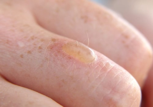 Effective Wound Treatment for 2nd Degree Burn Blister Healing Stages