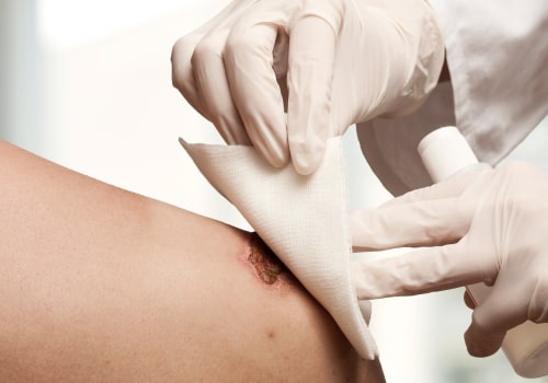 Navigating Your Treatment Options For A Denuded Skin Wound