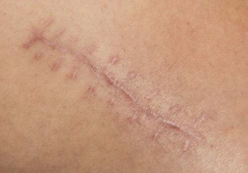 Expert Tips for Speeding Up Wound Healing