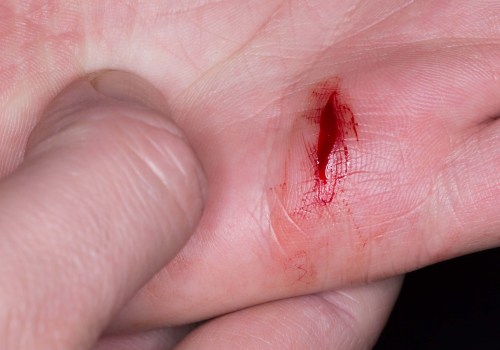 Expert Tips for Faster Wound Healing: How to Heal Wounds Quickly and Prevent Complications