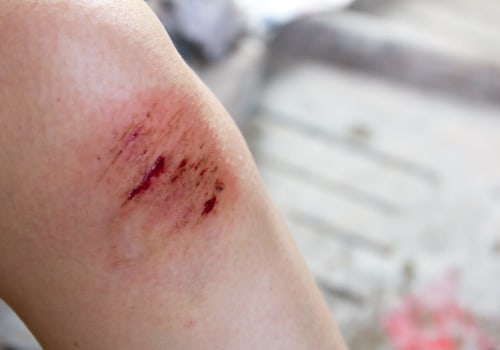 Edema Wound Treatment: Strategies For Healing And Managing Swelling