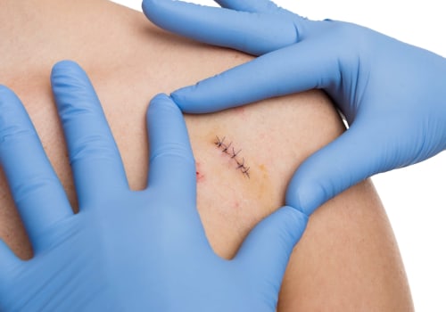 The Healing Process Uncovered: How Long Does It Take for Stitches to Dissolve After Treatment?