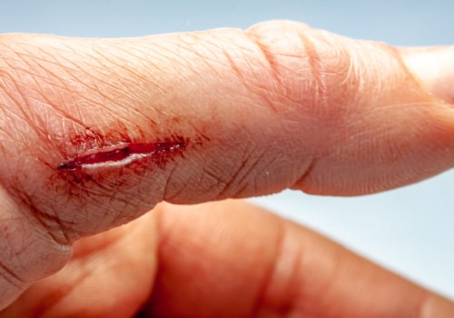 What Do Dissolvable Stitches Look Like? A Helpful Guide for Effective Wound Treatment