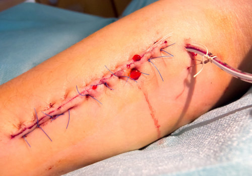 How to Navigate Normal Stitches Healing Stages With the Best Wound Care Practices